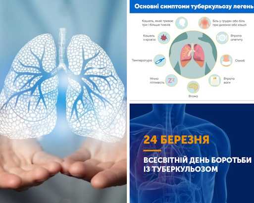 ТАК! МИ МОЖЕМО ПОДОЛАТИ ТУБЕРКУЛЬОЗ! ТАК! МИ МОЖЕМО ПОДОЛАТИ ТУБЕРКУЛЬОЗ!